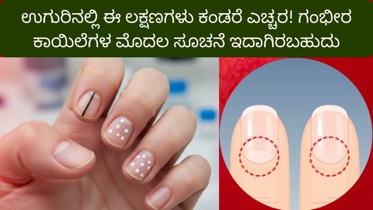 ಉಗುರಿನಲ್ಲಿ ಈ ಲಕ್ಷಣಗಳು ಕಂಡರೆ ಎಚ್ಚರ! ಗಂಭೀರ ಕಾಯಿಲೆಗಳ ಮೊದಲ ಸೂಚನೆ ಇದಾಗಿರಬಹುದು